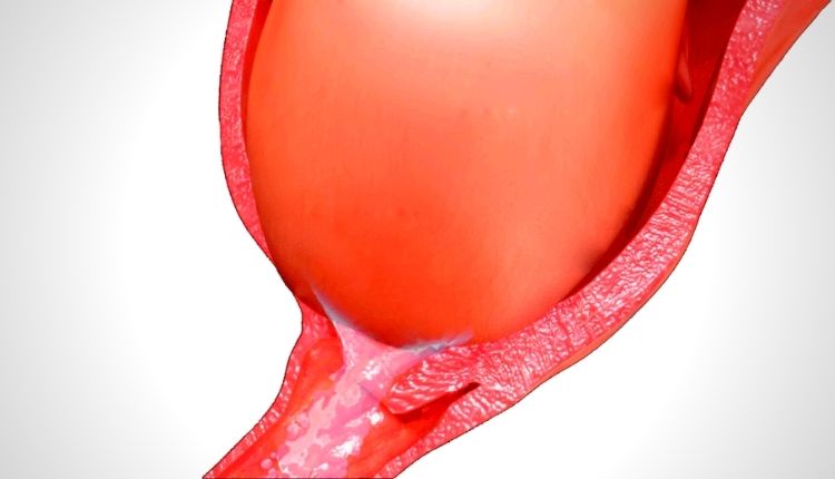 سدادة الرحم الشفافة وفوقها جزء من الرحم باللون الأحمر على خلفية بيضاء 